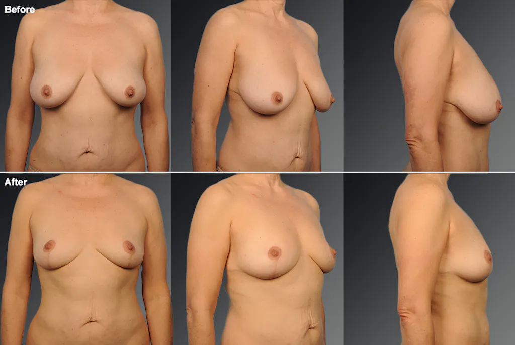 Breast Reduction Los Angeles
